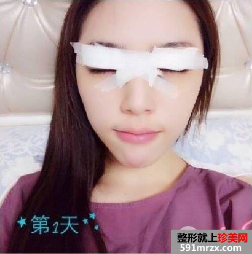 开眼角+双眼皮手术过程分享，还有很多术后效果图哦~
