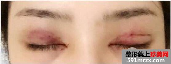 开眼角+双眼皮手术过程分享，还有很多术后效果图哦~