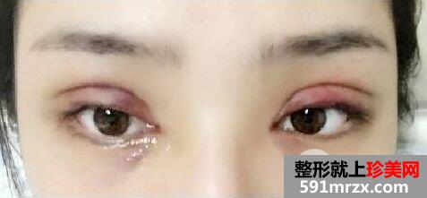 开眼角+双眼皮手术过程分享，还有很多术后效果图哦~