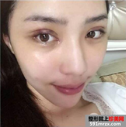 开眼角+双眼皮手术过程分享，还有很多术后效果图哦~