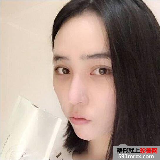 开眼角+双眼皮手术过程分享，还有很多术后效果图哦~