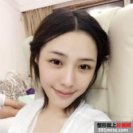 开眼角+双眼皮手术过程分享，还有很多术后效果图哦~