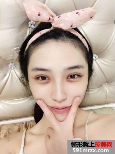 开眼角+双眼皮手术过程分享，还有很多术后效果图哦~