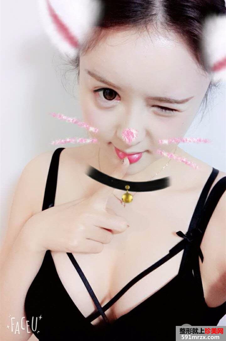 自体脂肪丰胸价格|真人案例效果对比照片分享