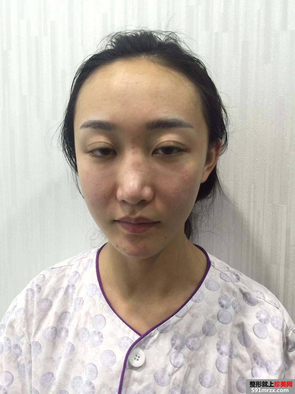 鼻部整形修复+自体脂肪面部填充真实案例，前后对比图分享