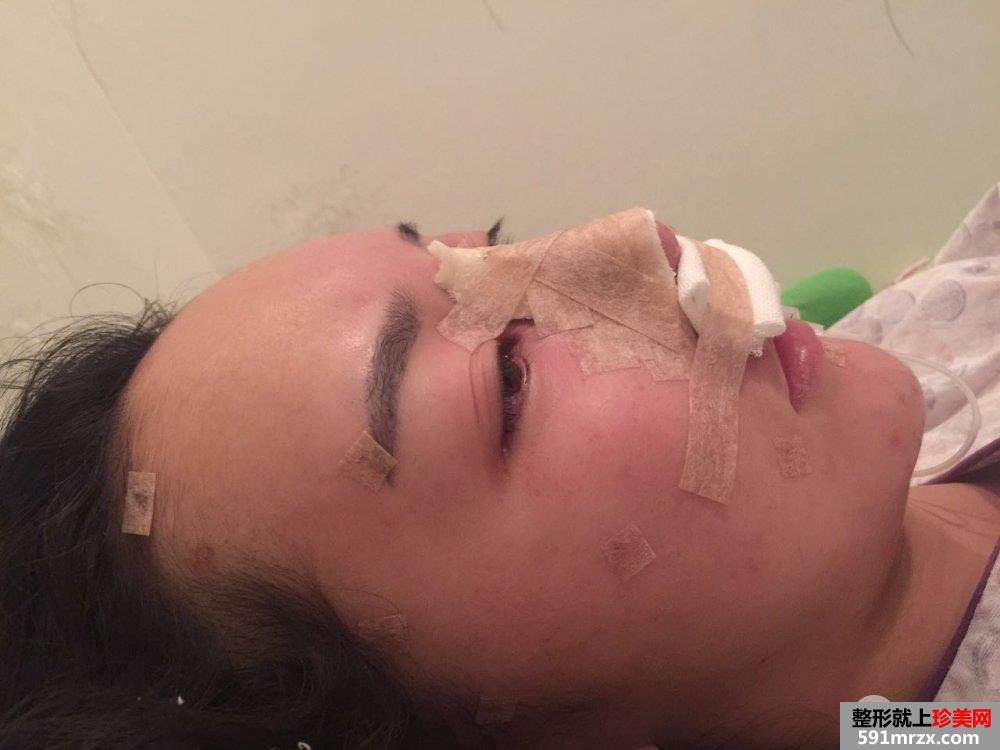 鼻部整形修复+自体脂肪面部填充真实案例，前后对比图分享