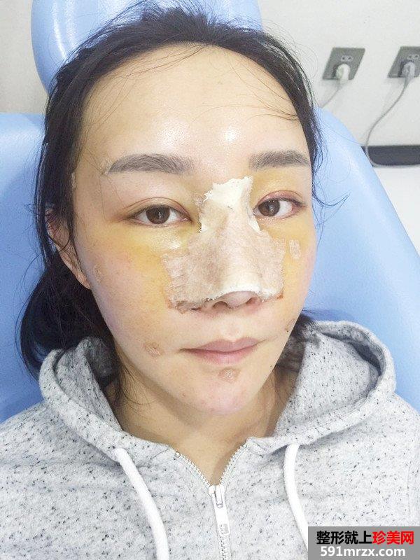 鼻部整形修复+自体脂肪面部填充真实案例，前后对比图分享