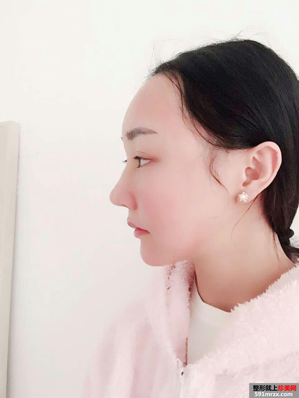 鼻部整形修复+自体脂肪面部填充真实案例，前后对比图分享