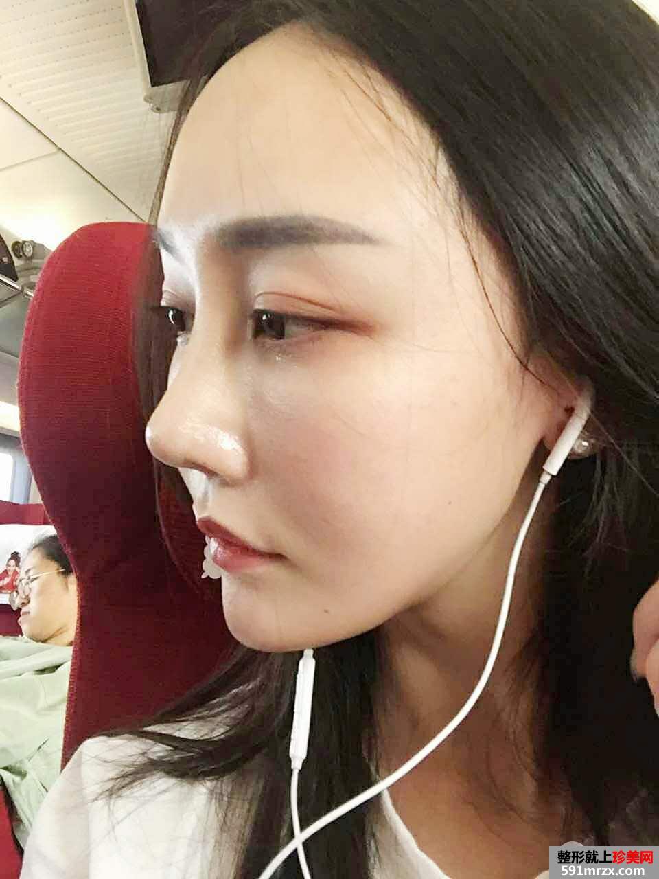 鼻部整形修复+自体脂肪面部填充真实案例，前后对比图分享