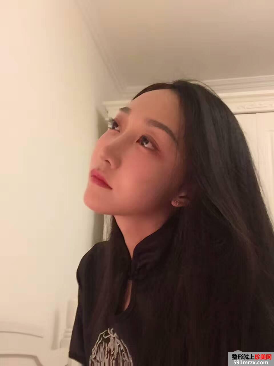 鼻部整形修复+自体脂肪面部填充真实案例，前后对比图分享
