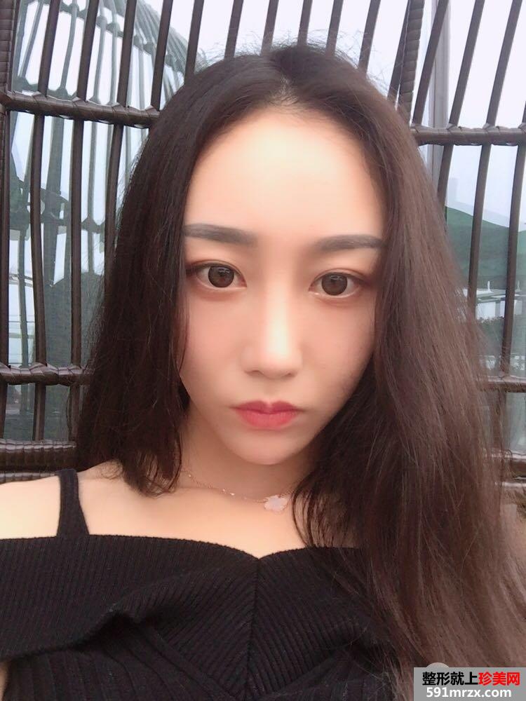 鼻部整形修复+自体脂肪面部填充真实案例，前后对比图分享
