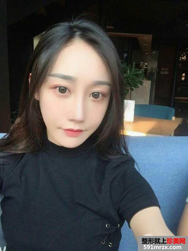 鼻部整形修复+自体脂肪面部填充真实案例，前后对比图分享