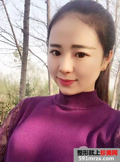 埋线面部提升真人效果对比图，立现鹅蛋脸
