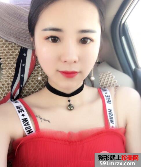 埋线面部提升真人效果对比图，立现鹅蛋脸
