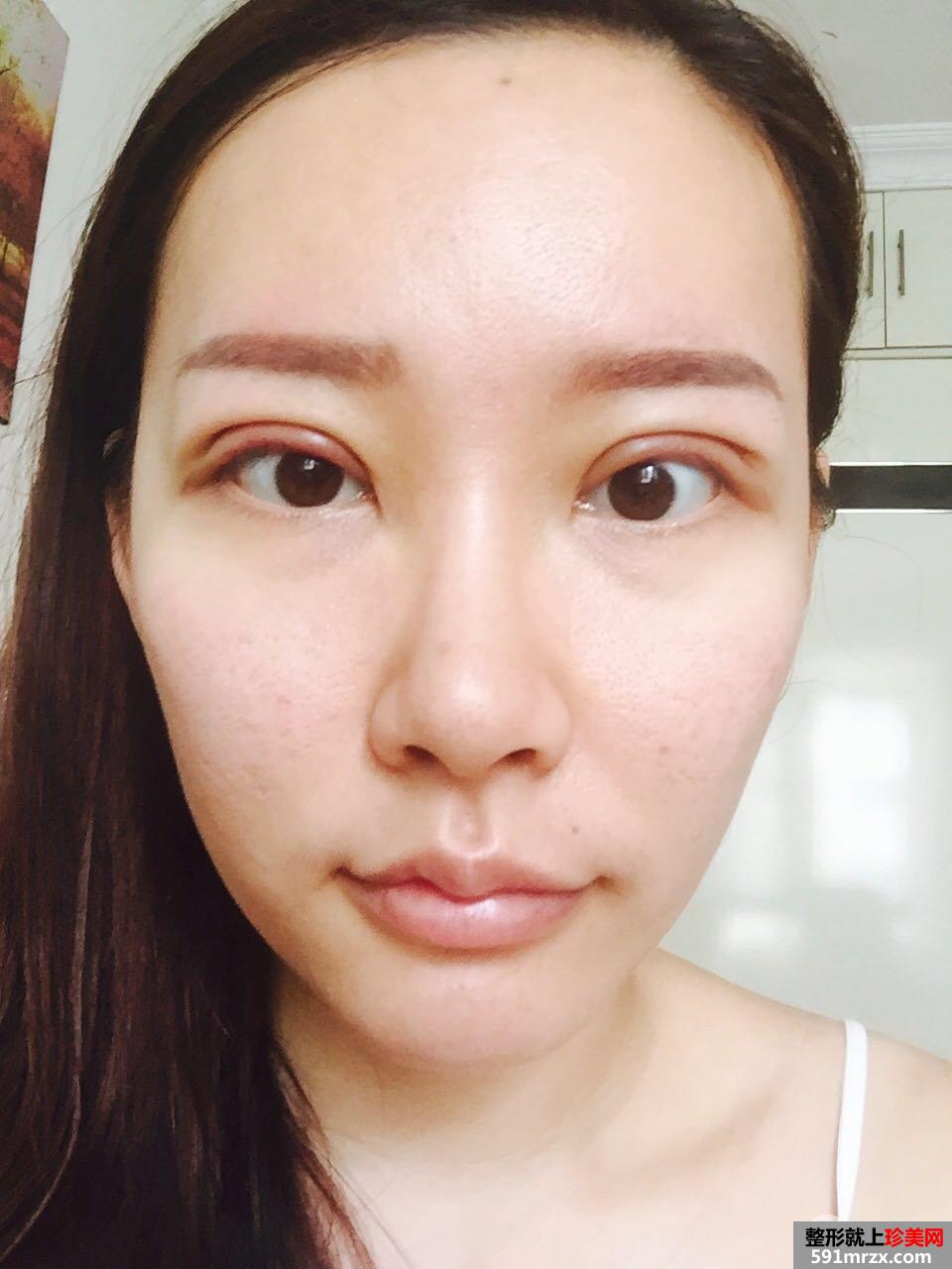 全切双眼皮+上睑下垂矫正手术案例对比照片，亲身经历分享