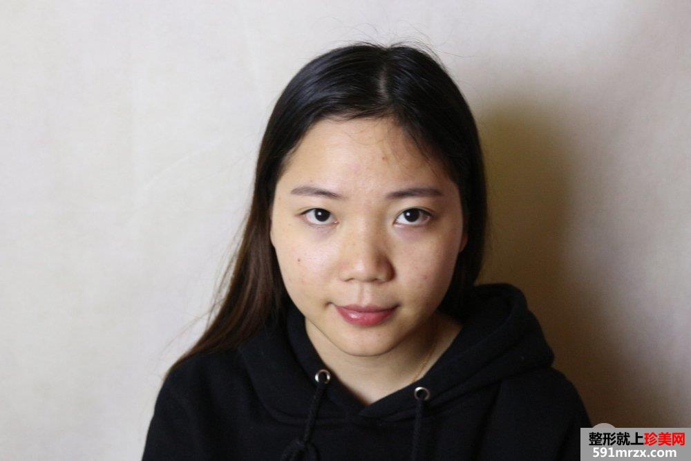 割双眼皮+鼻综合整形手术真人案例对比照片分享