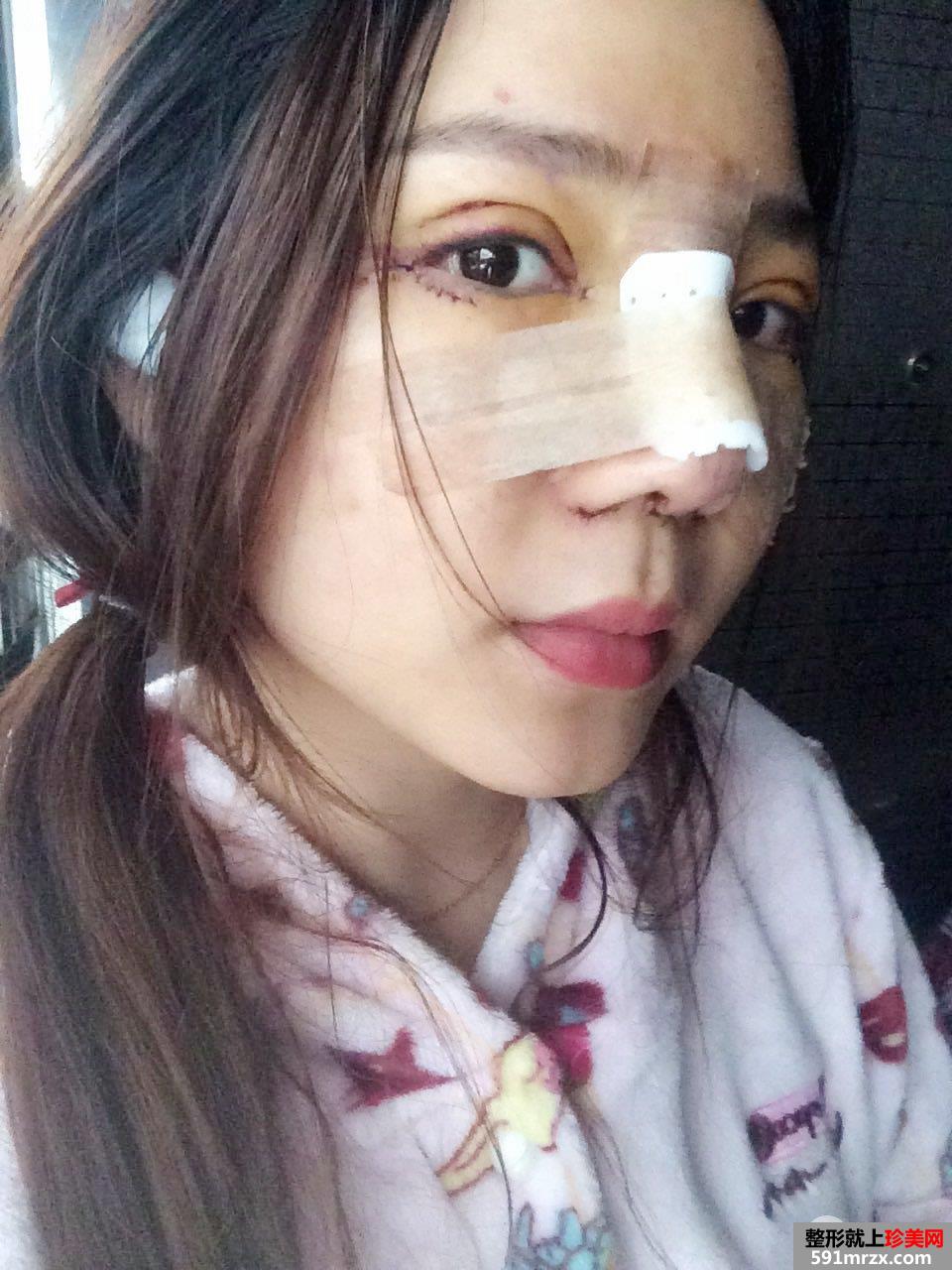 割双眼皮+鼻综合整形手术真人案例对比照片分享