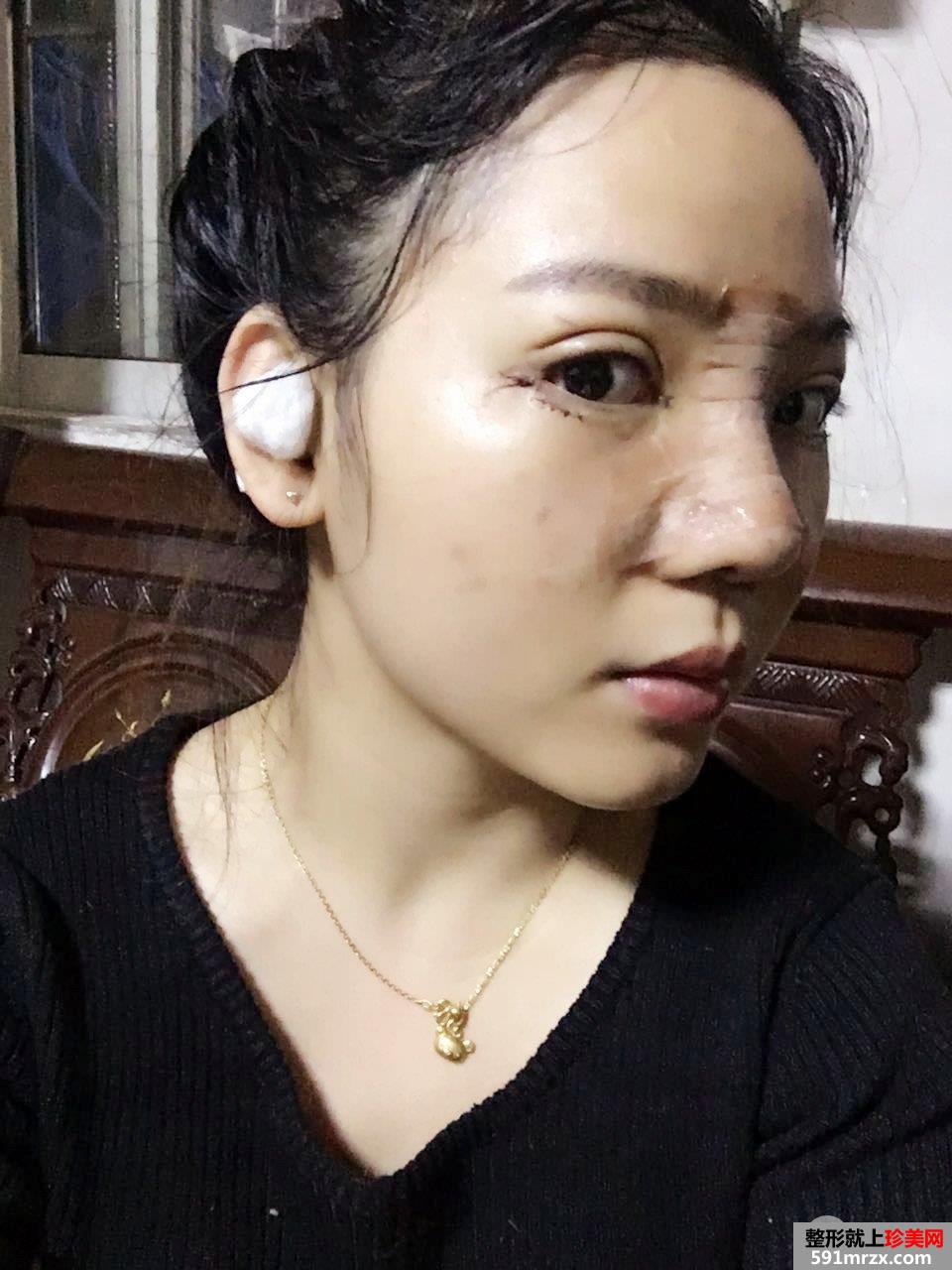 割双眼皮+鼻综合整形手术真人案例对比照片分享