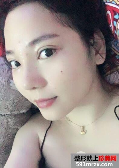 割双眼皮+鼻综合整形手术真人案例对比照片分享