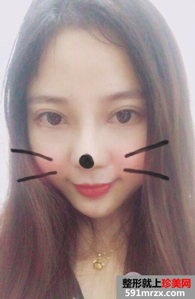割双眼皮+鼻综合整形手术真人案例对比照片分享