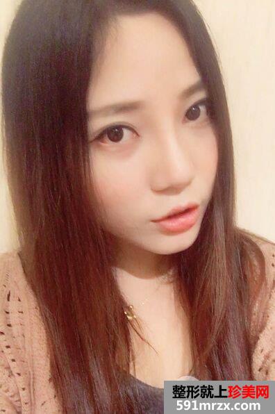 割双眼皮+鼻综合整形手术真人案例对比照片分享