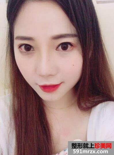 割双眼皮+鼻综合整形手术真人案例对比照片分享