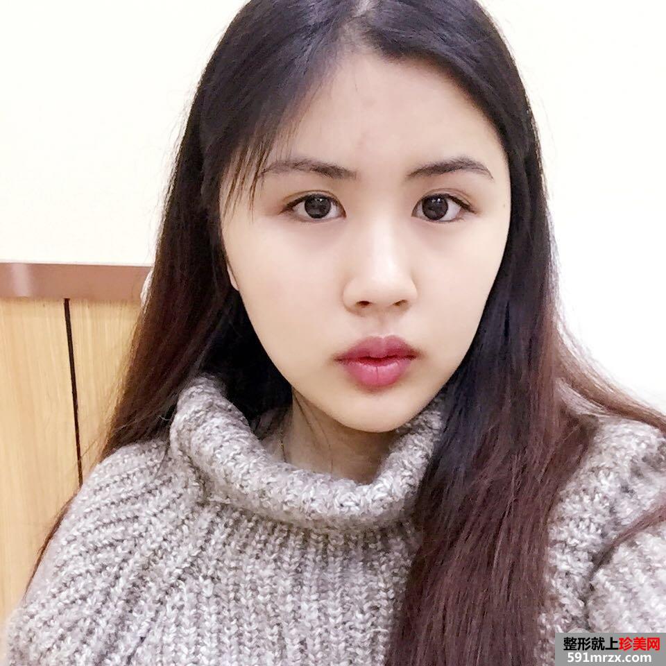 双眼皮修复+开眼角案例图片对比，欧式双眼皮get！