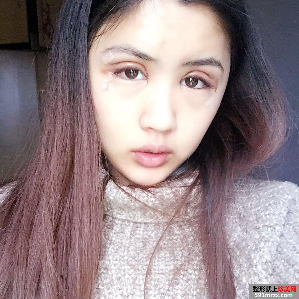 双眼皮修复+开眼角案例图片对比，欧式双眼皮get！