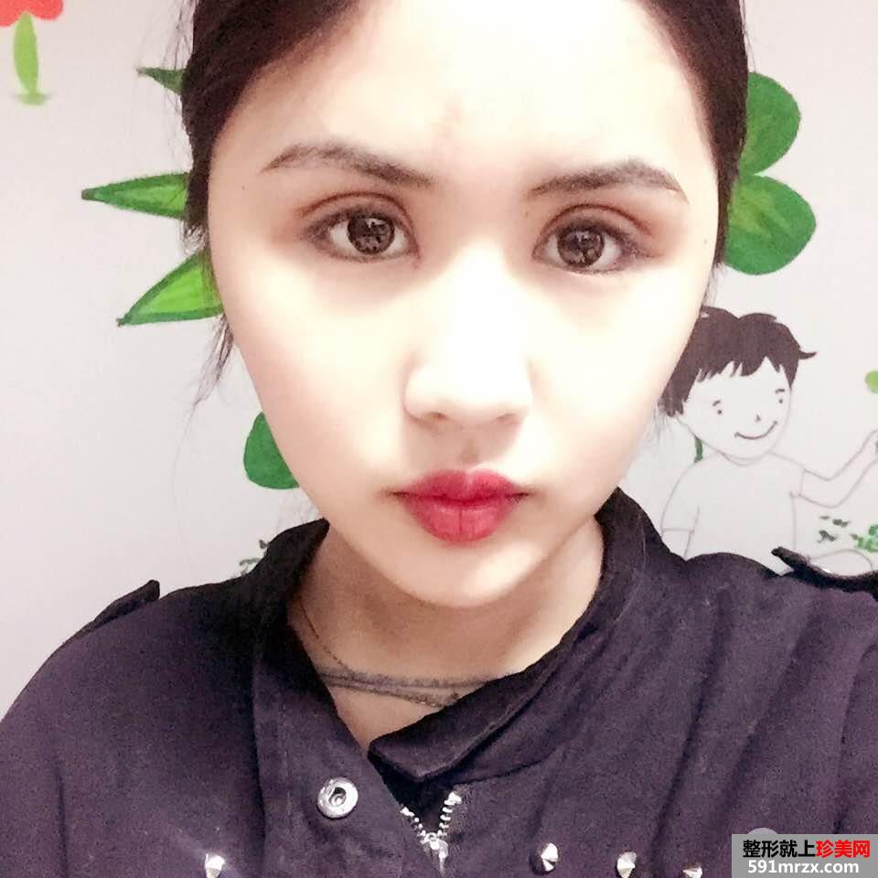 双眼皮修复+开眼角案例图片对比，欧式双眼皮get！