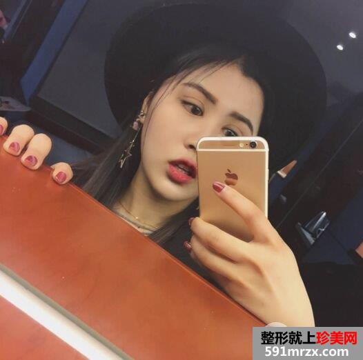 双眼皮修复+开眼角案例图片对比，欧式双眼皮get！