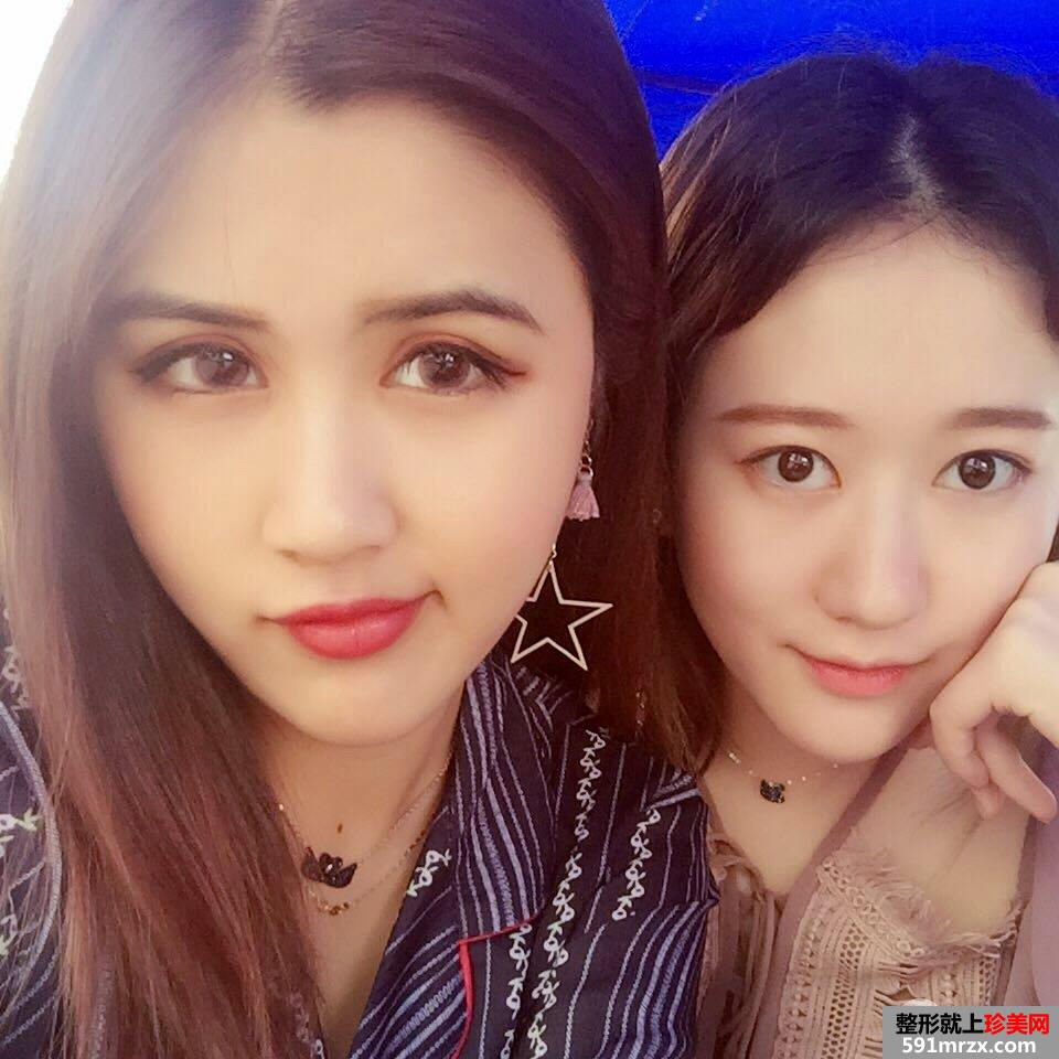 双眼皮修复+开眼角案例图片对比，欧式双眼皮get！