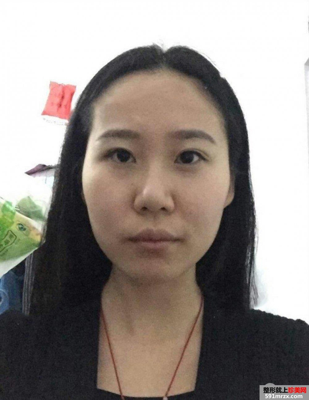 鼻综合整形+假体垫下巴恢复过程图真实案例分享