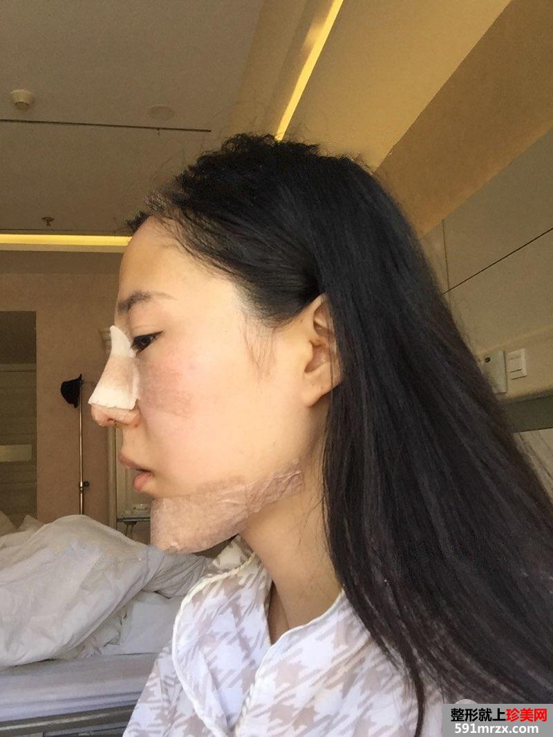 鼻综合整形+假体垫下巴恢复过程图真实案例分享
