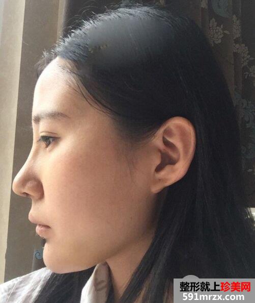 鼻综合整形+假体垫下巴恢复过程图真实案例分享