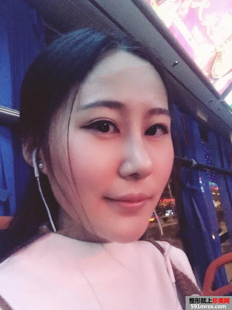 鼻综合整形+假体垫下巴恢复过程图真实案例分享