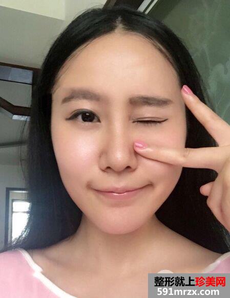 鼻综合整形+假体垫下巴恢复过程图真实案例分享