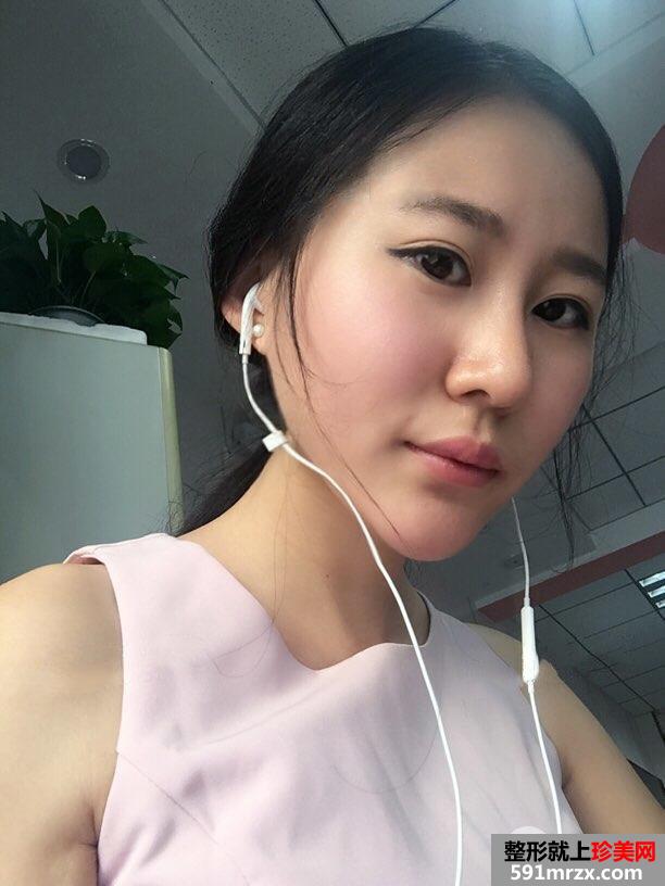 鼻综合整形+假体垫下巴恢复过程图真实案例分享