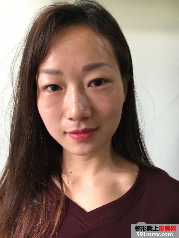 减龄神器自体脂肪全脸填充加PRP真实案例效果对比图