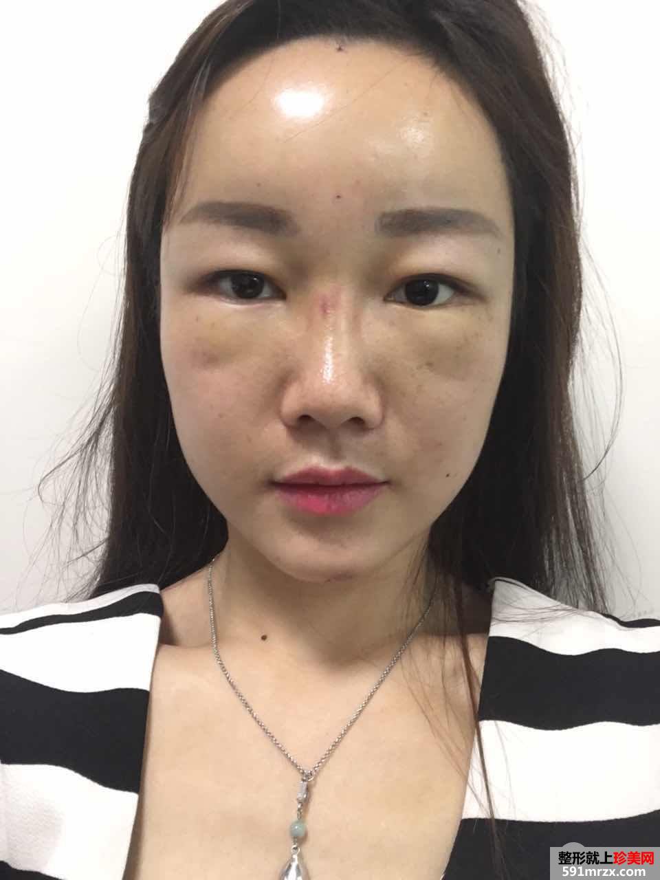 减龄神器自体脂肪全脸填充加PRP真实案例效果对比图