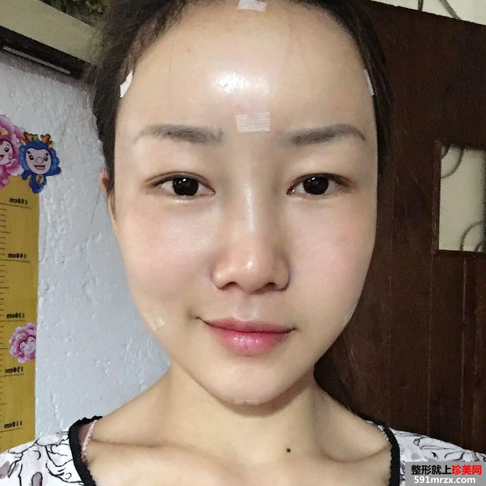减龄神器自体脂肪全脸填充加PRP真实案例效果对比图