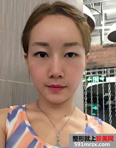减龄神器自体脂肪全脸填充加PRP真实案例效果对比图