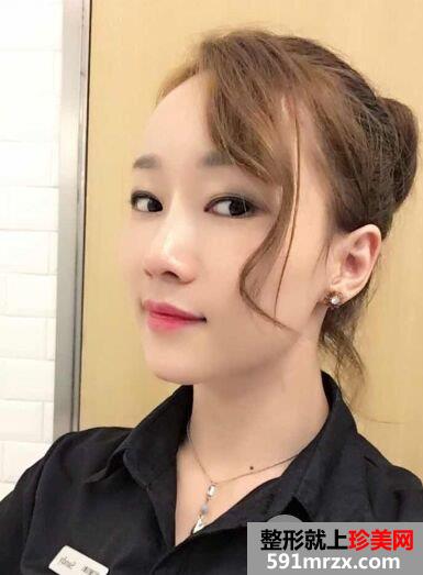 减龄神器自体脂肪全脸填充加PRP真实案例效果对比图