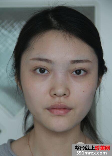 假体隆鼻+耳软骨垫鼻尖真实效果分享瞬间变女神