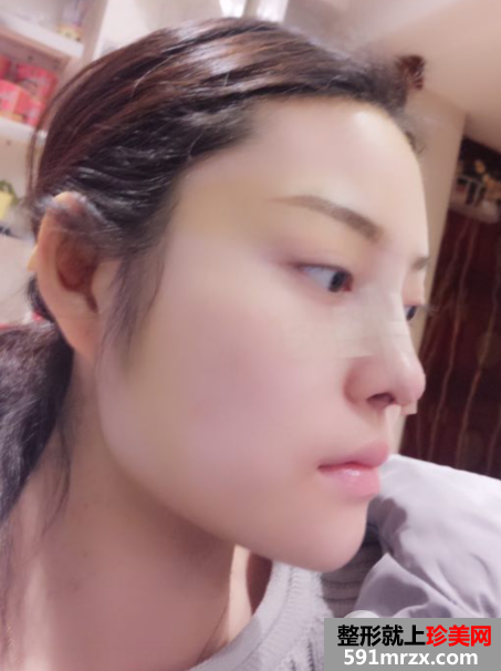 假体隆鼻+耳软骨垫鼻尖真实效果分享瞬间变女神