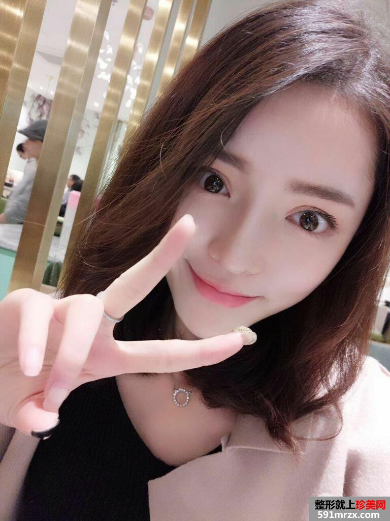 假体隆鼻+耳软骨垫鼻尖真实效果分享瞬间变女神
