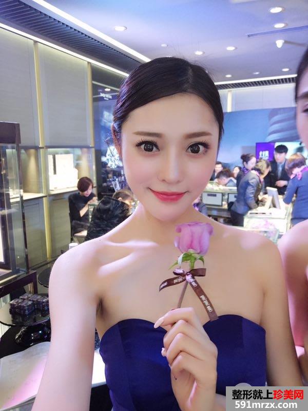 假体隆鼻+耳软骨垫鼻尖真实效果分享瞬间变女神