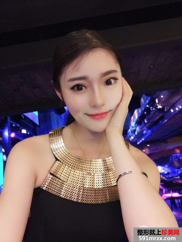 假体隆鼻+耳软骨垫鼻尖真实效果分享瞬间变女神