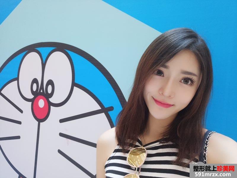 假体隆鼻+耳软骨垫鼻尖真实效果分享瞬间变女神