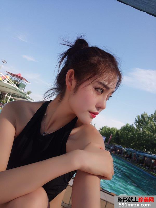 假体隆鼻+耳软骨垫鼻尖真实效果分享瞬间变女神