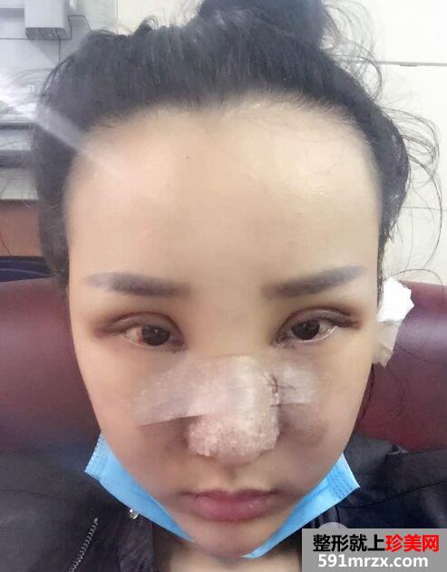  失败双眼皮修复+隆鼻修复手术对比照片，亲身经历分享